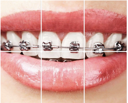 Self-Ligating Braces