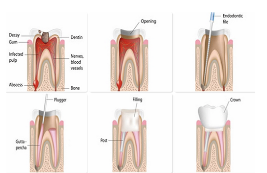 TADs / Micro Implants