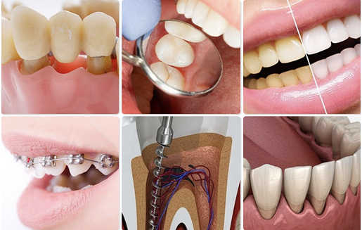 Root Canal Treatment (RCT)