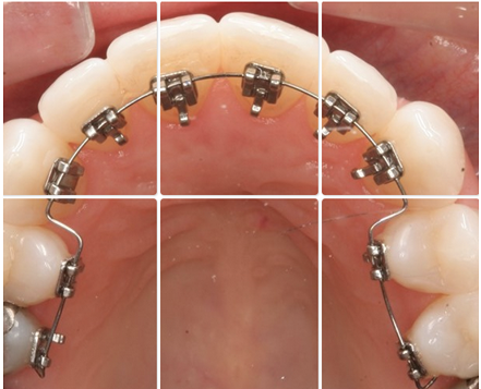 Lingual Braces
